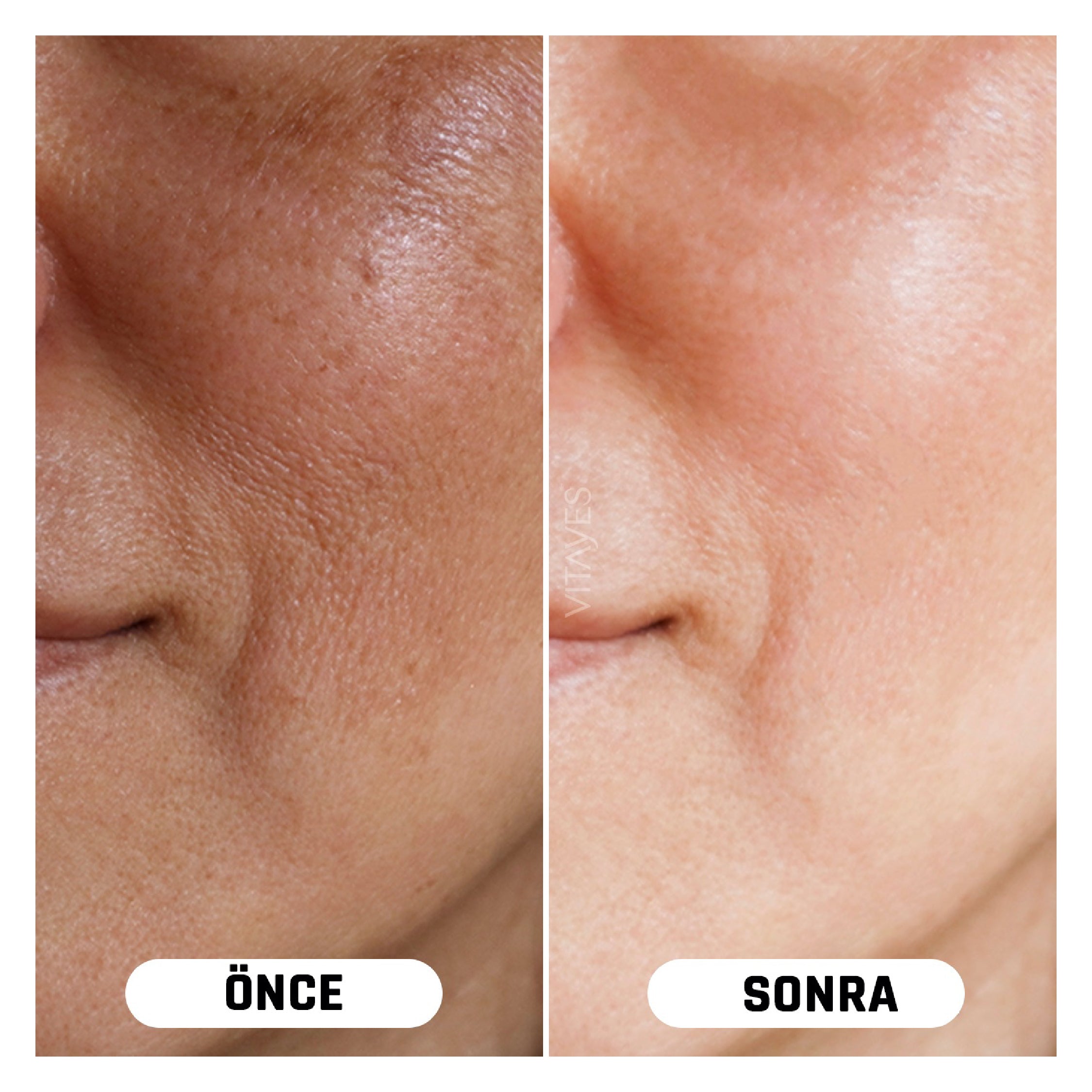 Koyu Lekelere Karşı Cilt Tonu Eşitleyici Vitayes C Vitamini Serum Parlak ve Canlandırıcı Etki