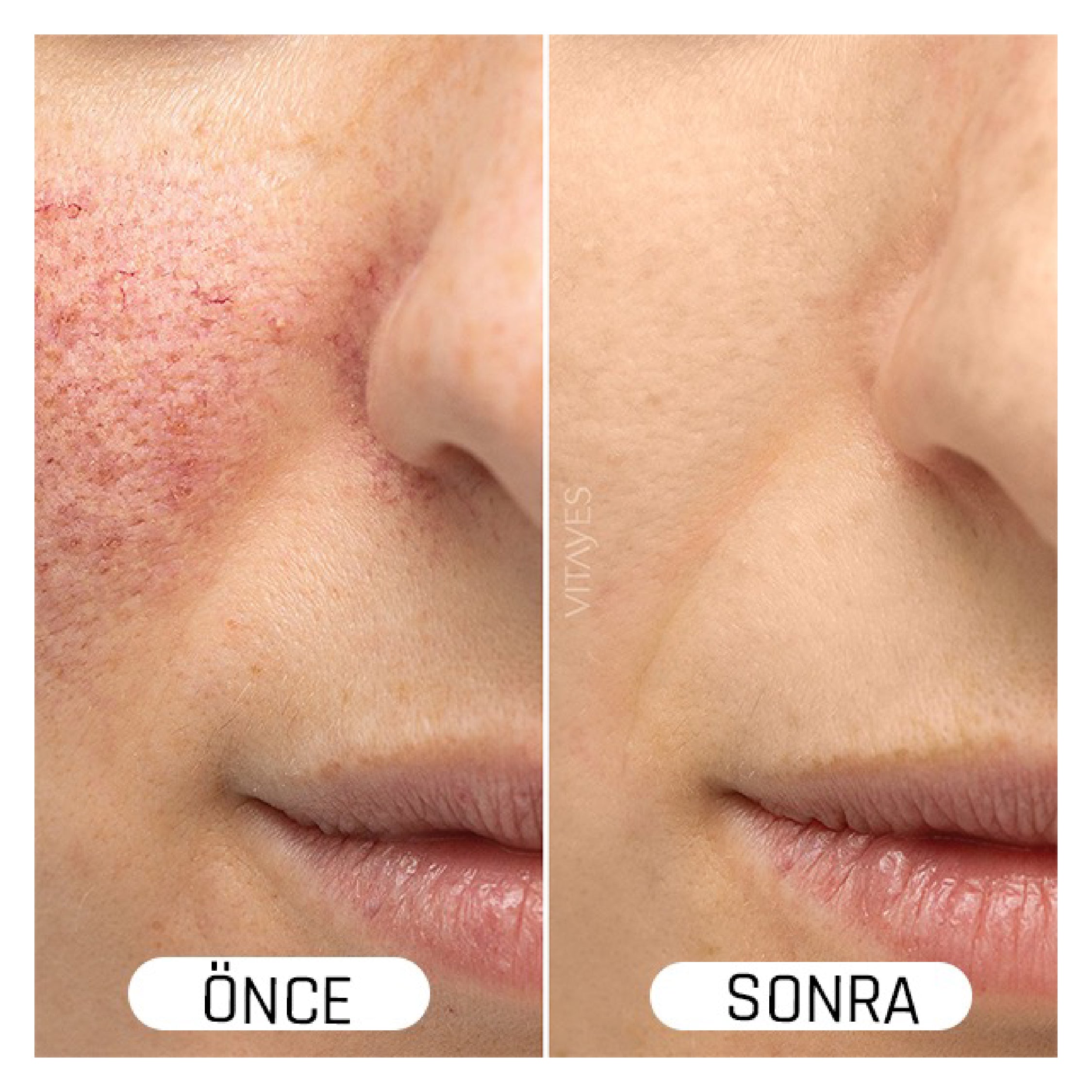Koyu Lekelere Karşı Cilt Tonu Eşitleyici Vitayes C Vitamini Serum Parlak ve Canlandırıcı Etki
